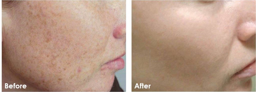 IPL-Photofacial-Before-After-1-1024x371.jpg