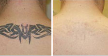 tattoo-removal-before-and-after-2.jpg